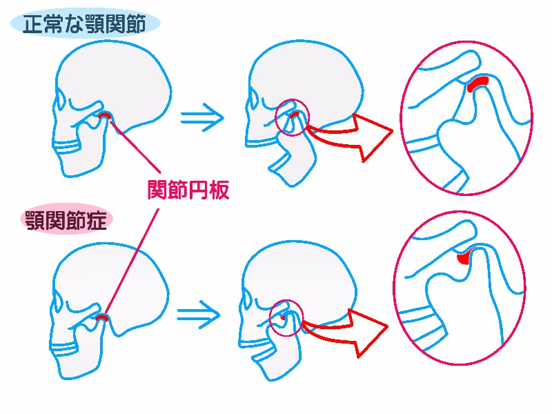 ストレスでも起こる顎関節症
